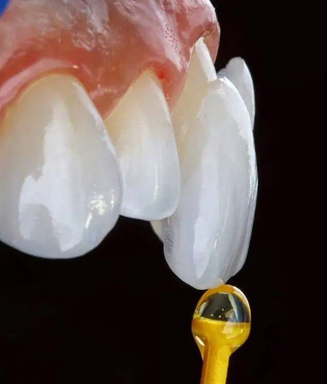 Ilustrație pentru procesul de aplixare al fațetelor dentare, un proces nedureros care tranfomră dantura într-una perfectă
