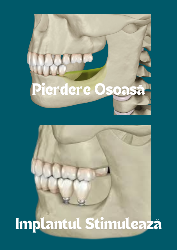 Pierderea osoasă odată cu pierderea dinților sau atunci când o punte este folosită și cum implantul dentar stimulează osul, prevenind resorbția. Punte VS Implant