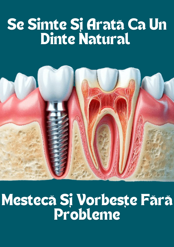 Implant VS Punte - ilustrare a unui implant lângă un dinte natural, pentru a sublinia aspectul natural, funcționalitatea dar și faptul că previne resobția osoasă