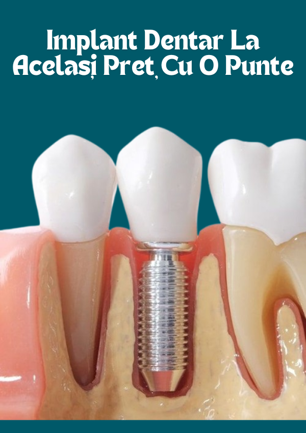 Implant VS Punte - ilustrare a unui implant între dinți naturali, imagine 3D Corectă medical