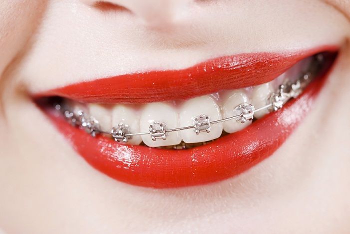 zâmbet frumos cu buze roșii și un aparat dentar discret