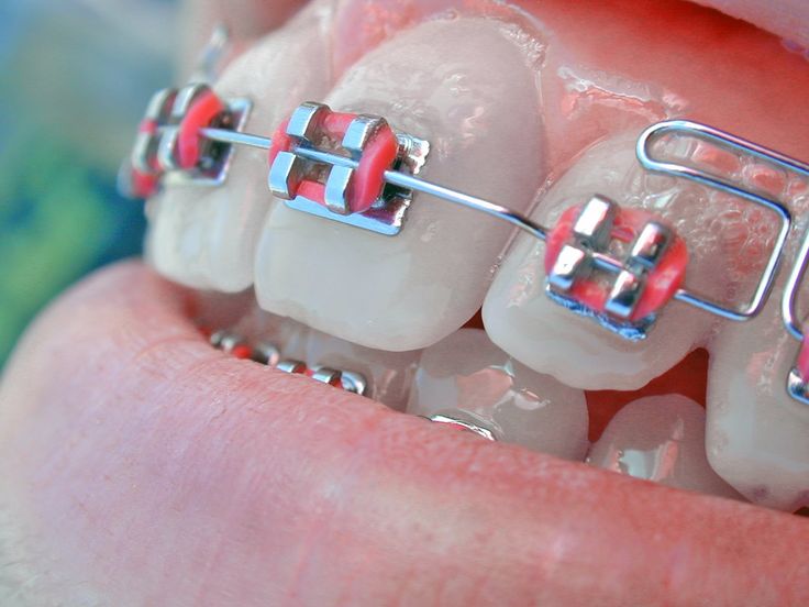 dinți albi și frumoși imbrăcați în aparat dentar colorat