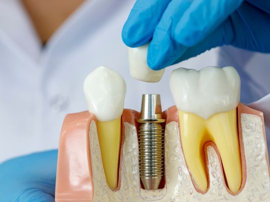 implant dentar văzut într-o gingie secționată pentru ilustrare, imagine realistică și corectă medical