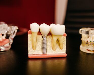 implant dentar văzut în gingie secționată, nu este o gingie reală, este un model 3d