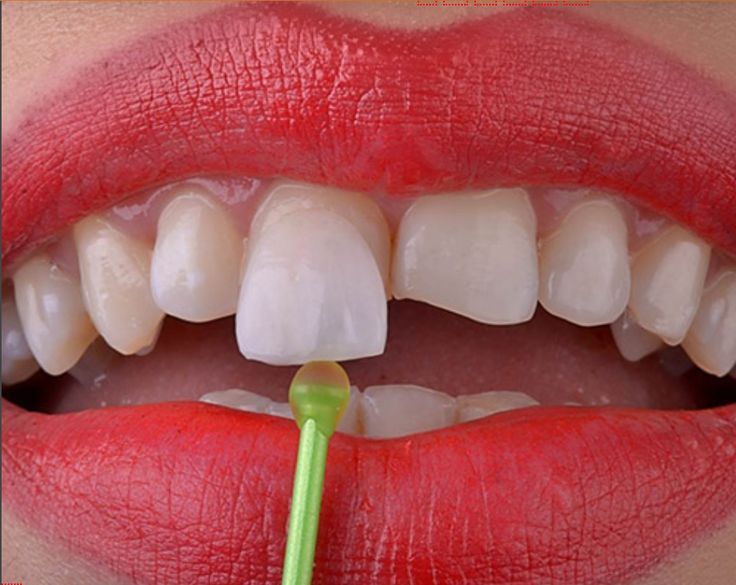 aplicarea fațetelor dentare unei femei cu buze roșii